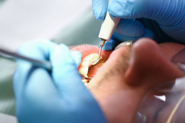Best Root Canal Emergency Dentist  in Harbor Hills, OH